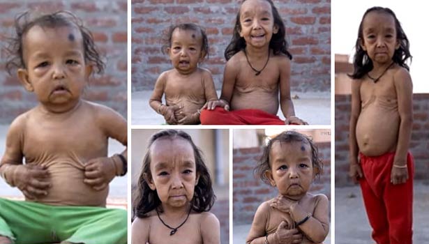 201604171210226996_Jharkhand-siblings-suffer-from-rare-condition-that-makes_SECVPF