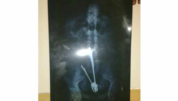 201605011806162345_18-year-woman-from-the-stomach-removal-scissor-Cole_SECVPF