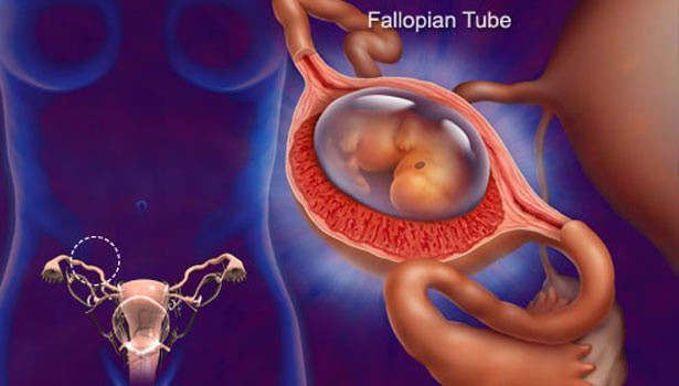 கருக்குழாய்-கர்ப்பம்-615x350