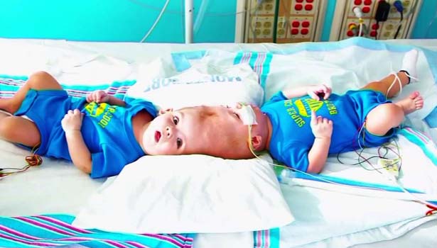201610151030429387_conjoined-twins-attached-at-head-separated-after-surgery-in_secvpf