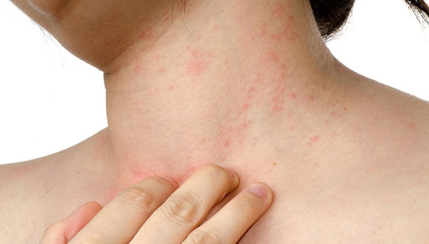 201612010925116262_unknown-illness-psoriasis_SECVPF