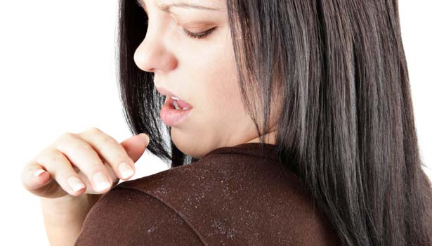 201701161000162296_Natural-ways-to-bring-immediate-relief-to-dandruff_SECVPF