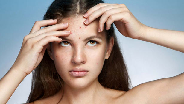 201701171346416651_pimples-main-reasons_SECVPF