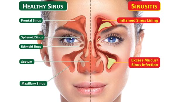 201701180823435218_reason-for-sinus-trouble_SECVPF