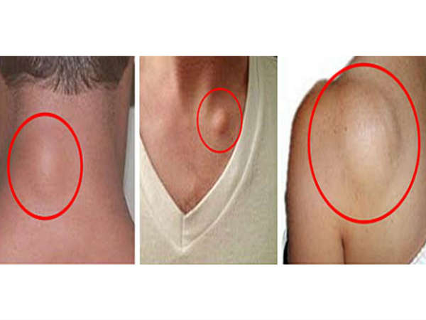 06-1486378427-4-lipoma