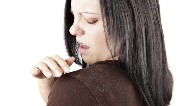 201702140928059071_problem-of-dandruff_SECVPF