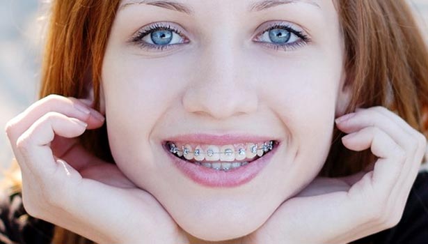 201702221417195764_Orthodontic-braces-Clip-wearing-dental-considerations_SECVPF