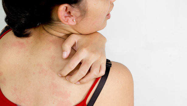 201702231118073971_Exposure-of-skin-itching-disease_SECVPF