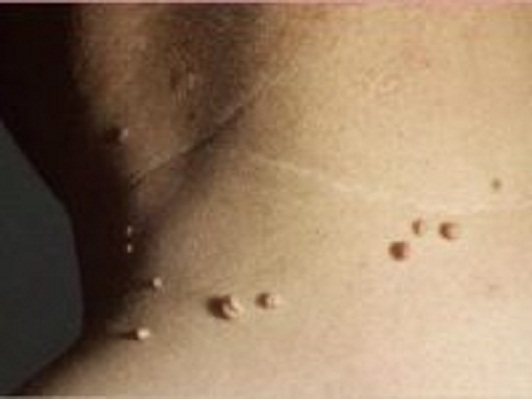 மருக்கள்-உங்கள்-அழகைக்-கெடுக்கிறதா-கவலைய-விடுங்க…-வெங்காயம்-போதும்