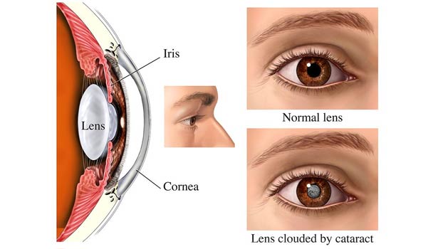 201702280826598573_cataract-solutions_SECVPF