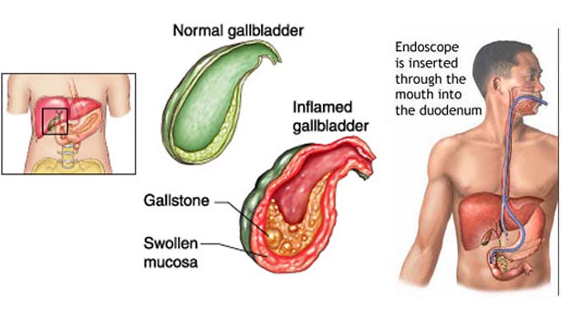 201703031151185014_Gallbladder-stones_SECVPF