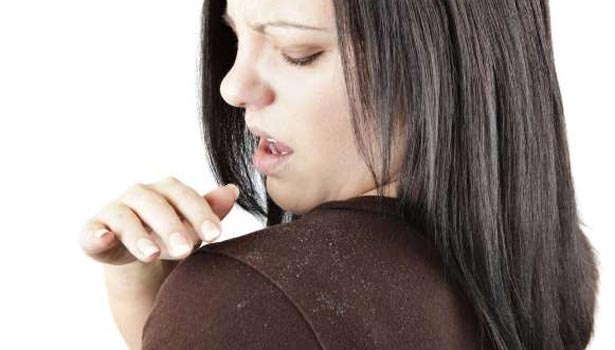 201703061345219852_natural-treatment-for-hair-lices-dandruff_SECVPF (1)