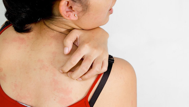 201703271442227301_summer-Itching-problem_SECVPF