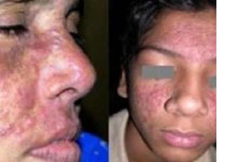 பேர்னஸ்-க்ரீம்-உபயோகிப்பவர்களுக்கு-ஓர்-எச்சரிக்கை-பதிவு