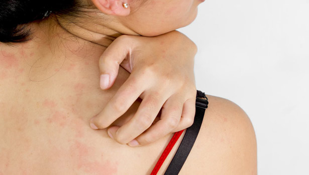 201705091145156931_summer-prickly-heat-rashes-natural-ways_SECVPF