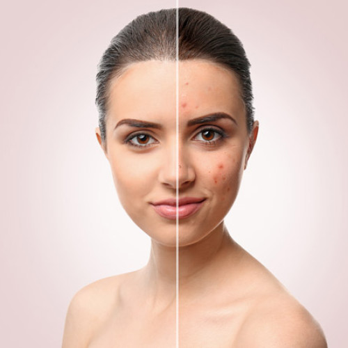 pimple-scars-500x500