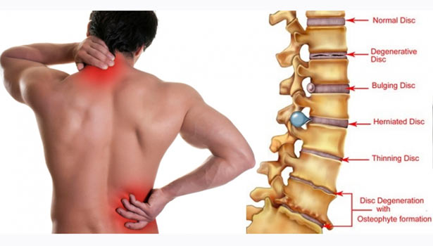 201706060840203921_Common-causes-of-back-pain_SECVPF