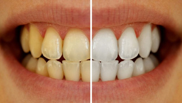201706121453173659_yellow-stains-on-teeth-natural-way_SECVPF