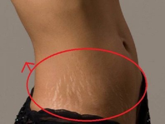 201707111614162290_how-to-get-rid-stretch-marks-for-women_SECVPF-400x300
