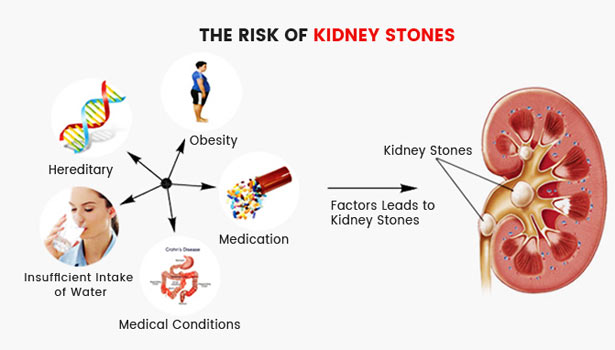 201708120838578451_kidney-stones-problem-solve_SECVPF