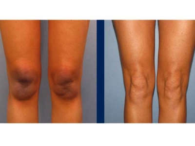 கை மற்றும் கால் முட்டிகளில் உள்ள கருமையை போக்க வேண்டுமா???..!!