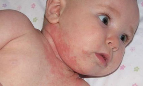 குழந்தைகளுக்கு வியர்க்குரு வருதா (Prickly Heat)!! (மருத்துவம்)