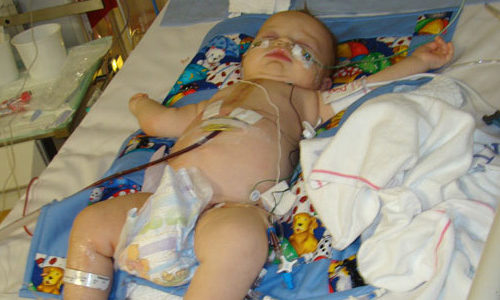 இதய அறுவை சிகிச்சை செய்யப்பட்டக் குழந்தைக்கு…!! (மருத்துவம்)